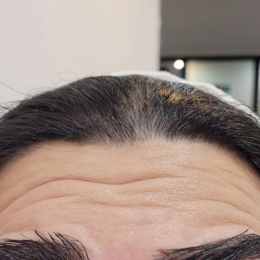 قبل از بوتاکس پیشانی