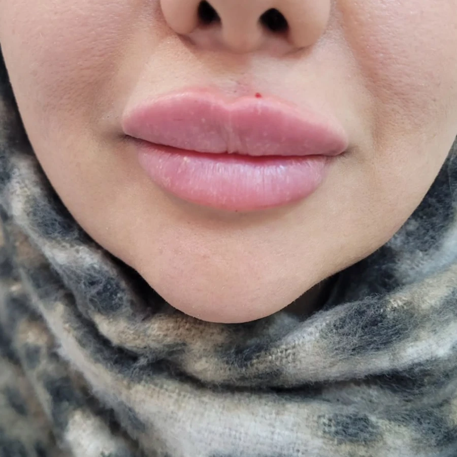 بعد از فیلر لب