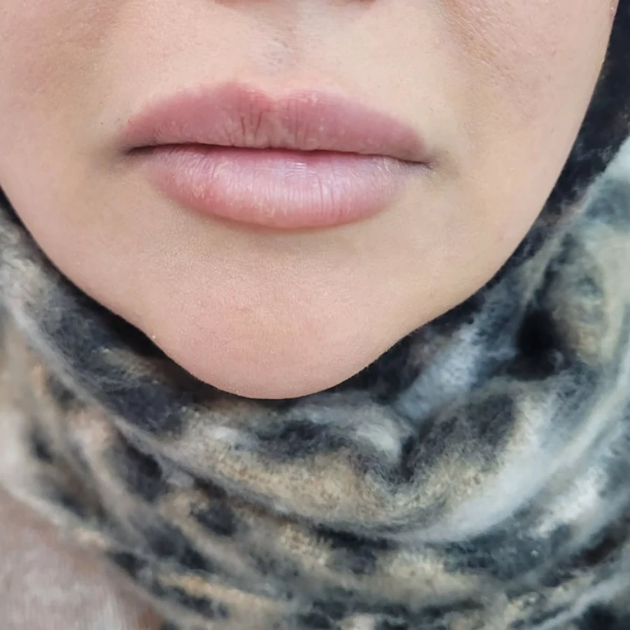 قبل از فیلر لب