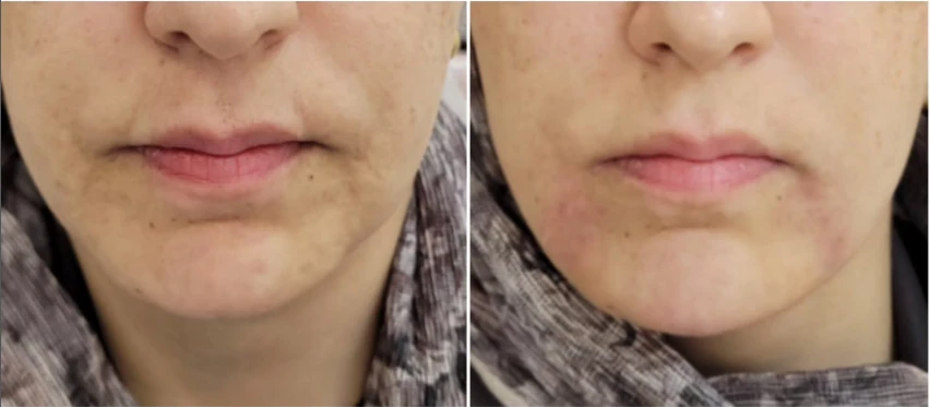 نمونه قبل و بعد اصلاح خطوط پایین صورت